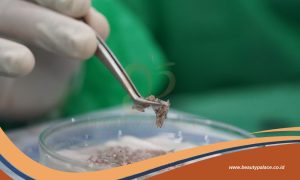 Bingung Bedanya Grafts dan Helai dalam Hair Transplant Simak Penjelasannya!