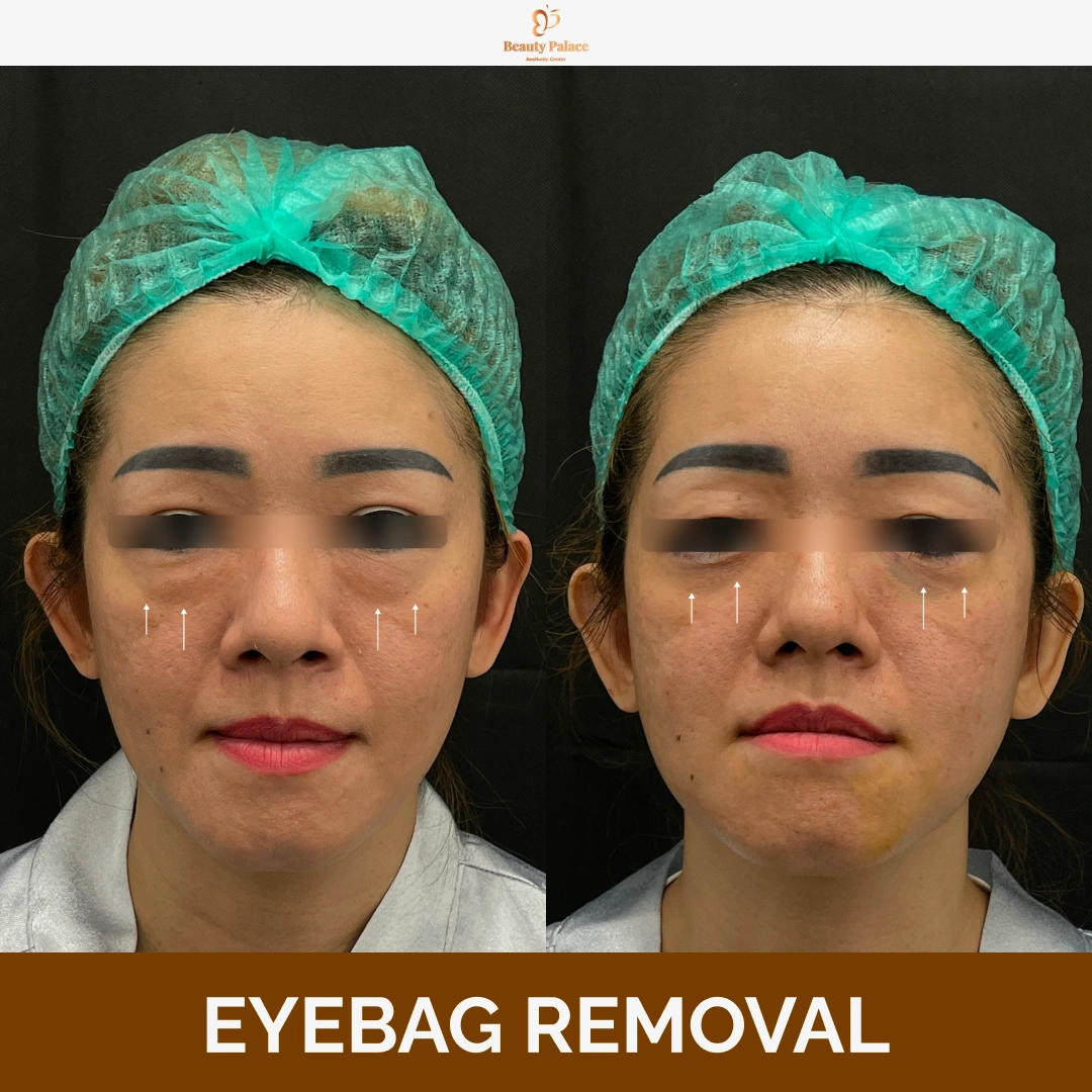 Eyebag Removal 1