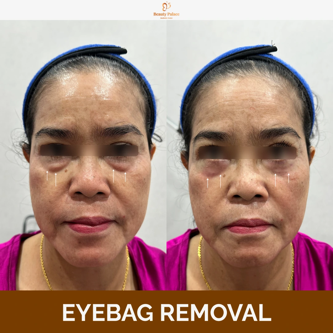 Eyebag Removal 3