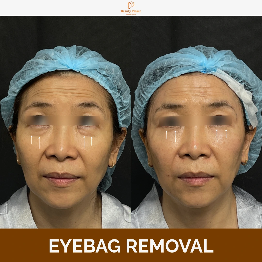 Eyebag Removal 4