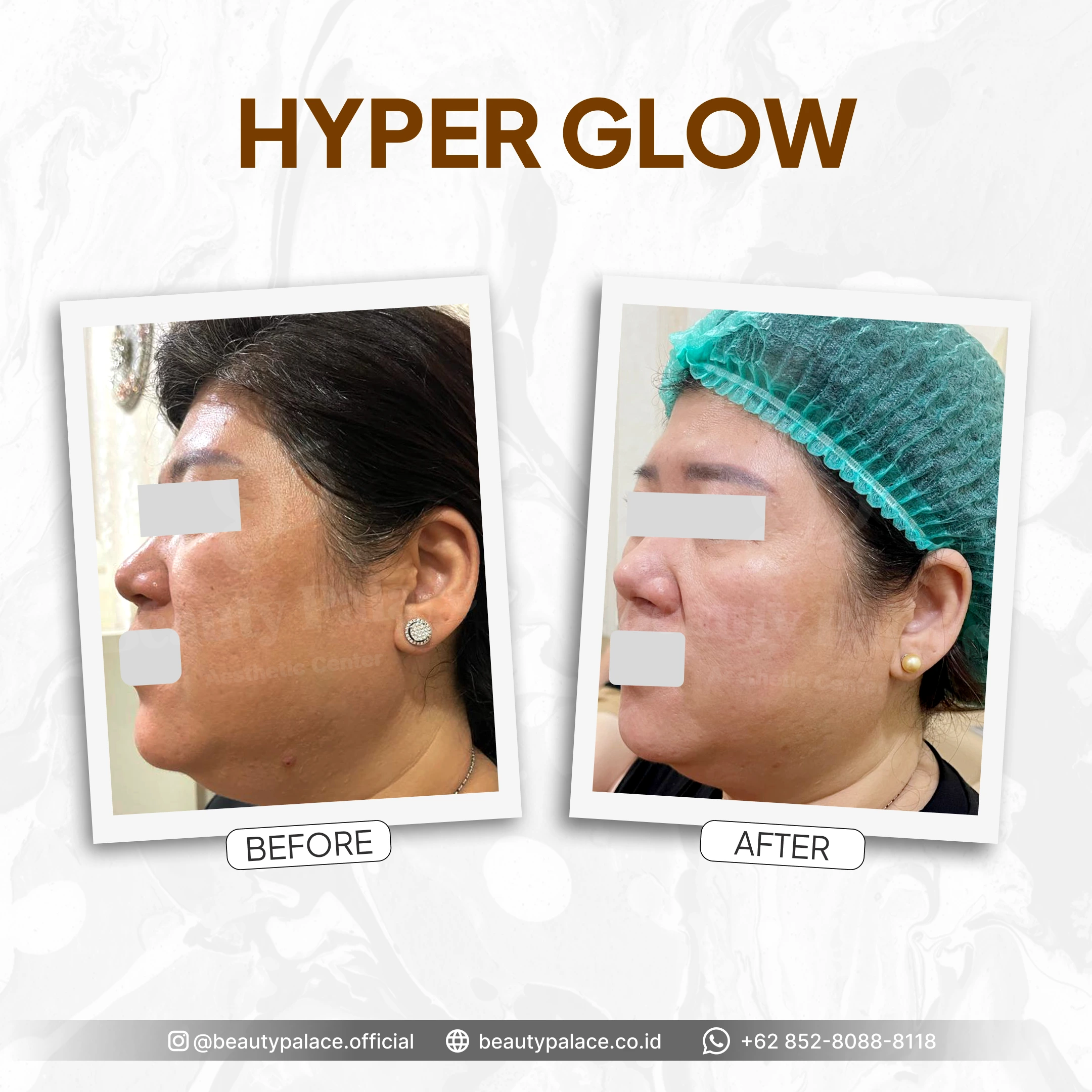 HyperGlow 1