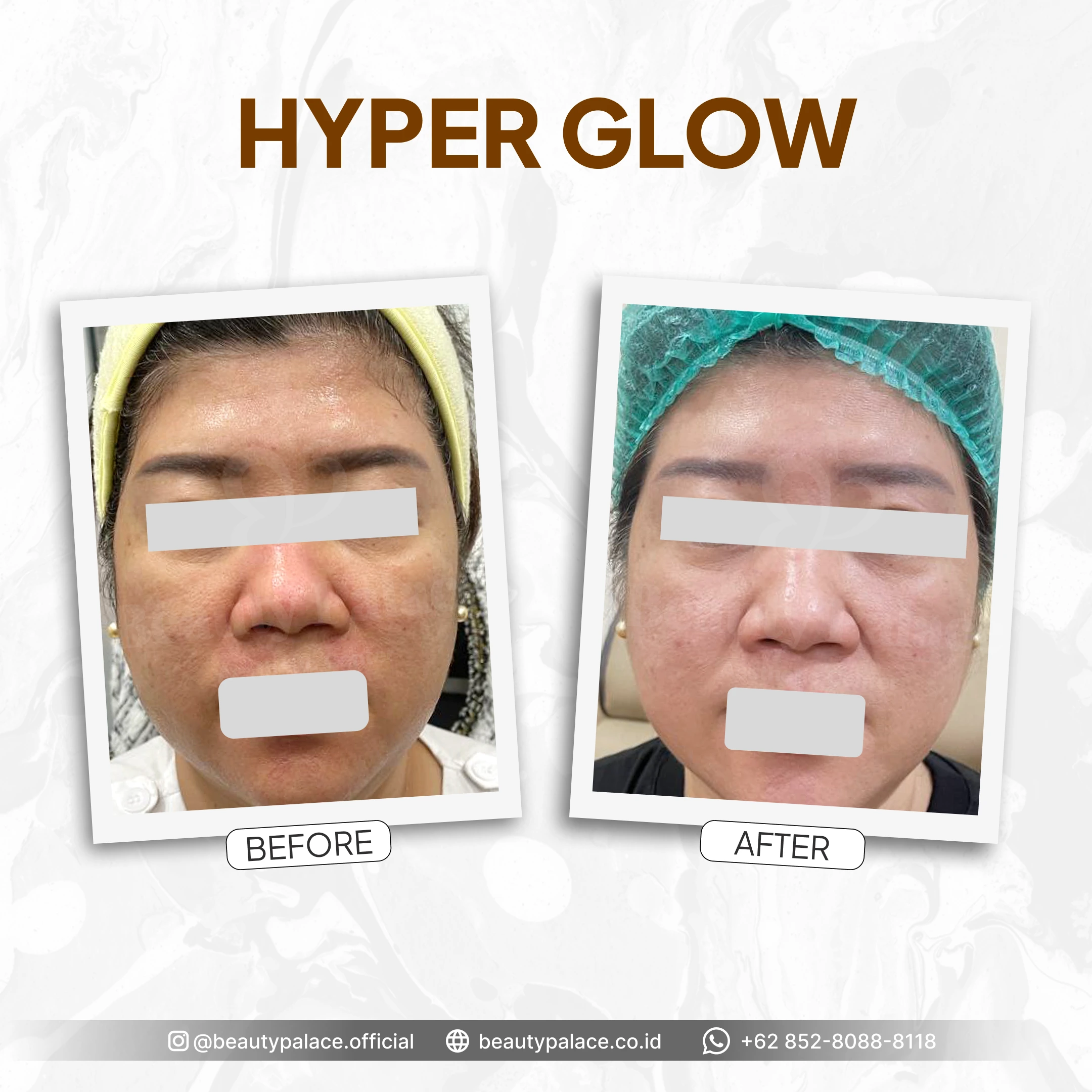 HyperGlow 5